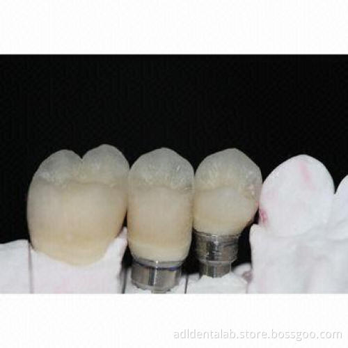 Implant bridge, highly predictable, esthetic